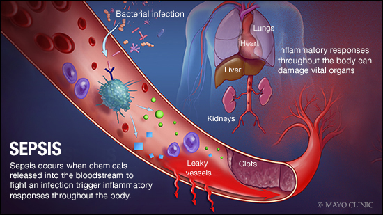 Sepsis Complications: How Nursing Homes Should Prevent & Treat